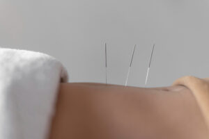 manfaat akupunktur medik