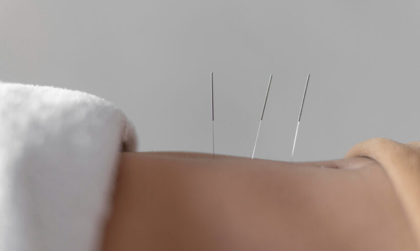 manfaat akupunktur medik