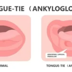 Tongue tie
