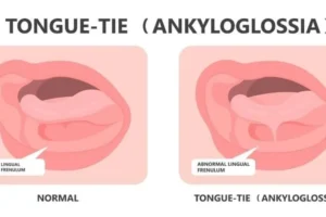 Tongue tie