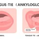 Tongue tie