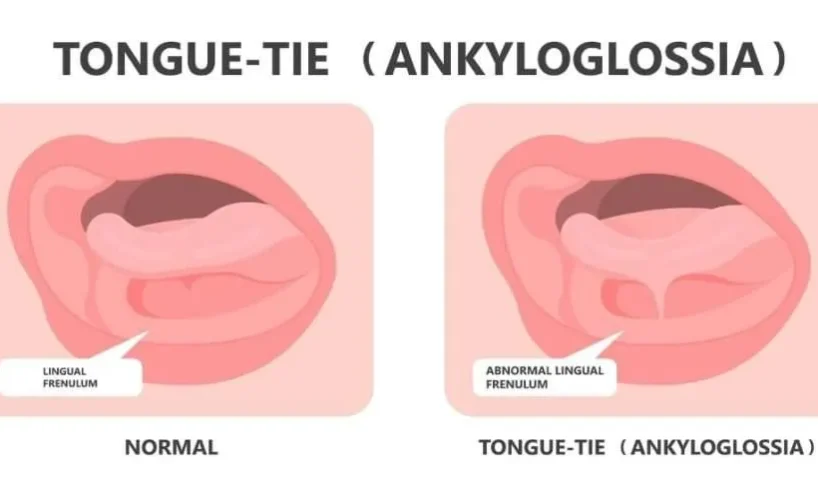 Tongue tie