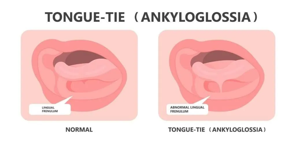 Tongue tie